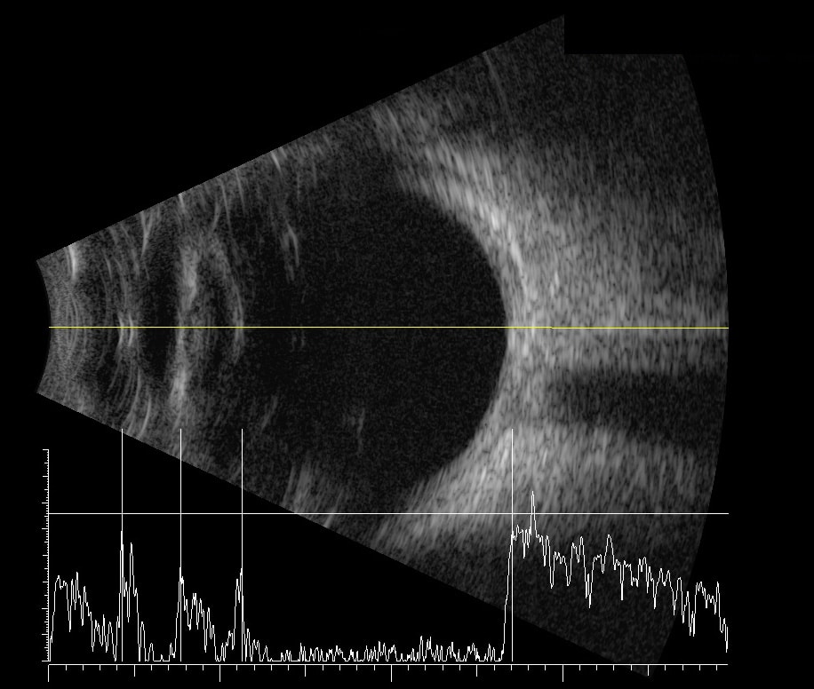 Biométrie oculaire par échographie avant chirurgie de la cataracte