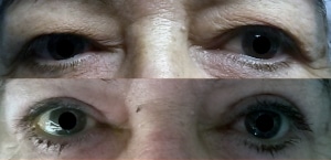 Image du haut : dermatochalasis bilatéral Image du bas : après blépharoplastie supérieure, aspect à 2 mois