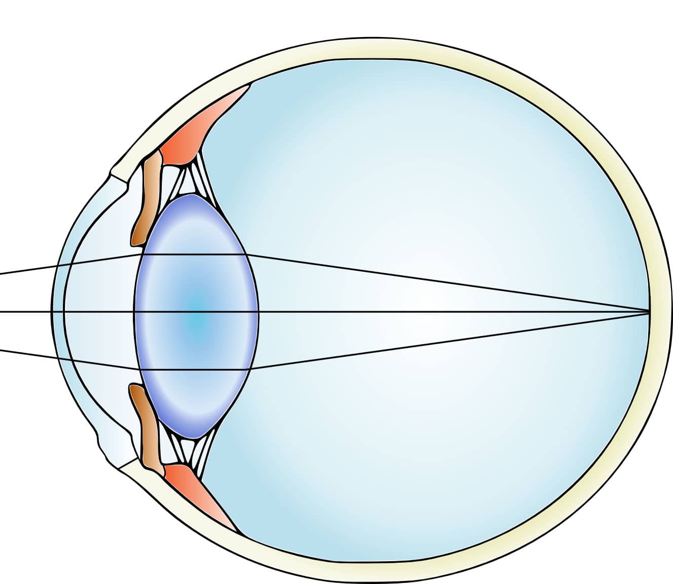 Фокусировка глаза человека. Ход лучей близорукость и дальнозоркость. Близорукость и дальнозоркость изображение на сетчатке. Ход лучей в глазе при близорукости и дальнозоркости. Ход лучей в миопическом глазу.