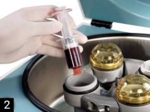 arthrex_prp_etape2 PRP : plasma riche en plaquettes