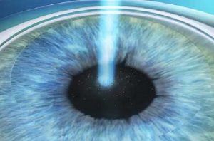 Cirurgia laser da miopia, presbiopia, astigmatismo, hipermetropia